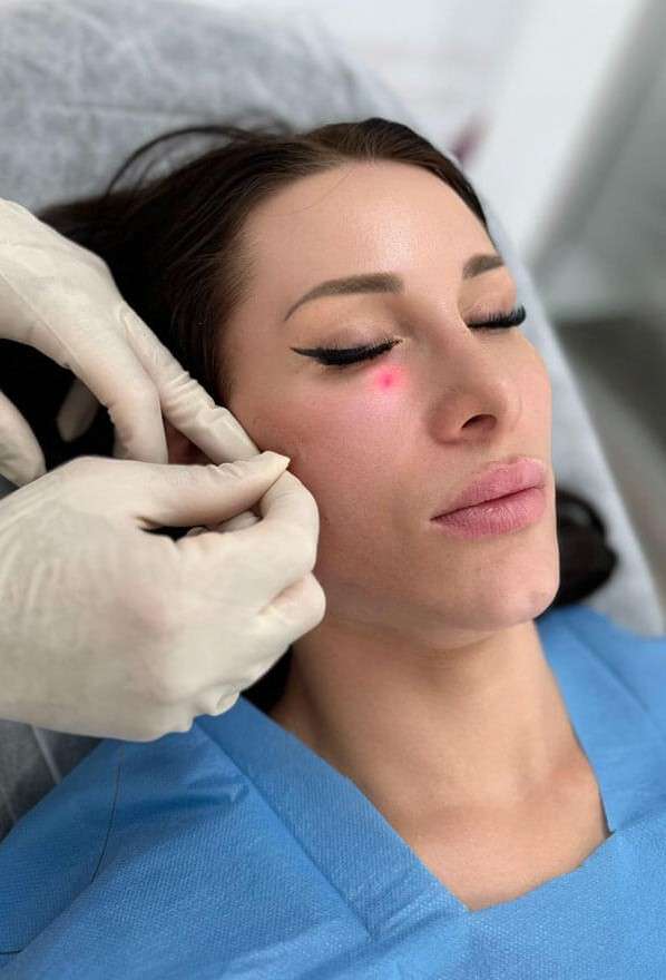 Endolift